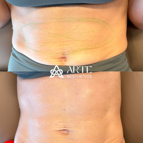Before and after