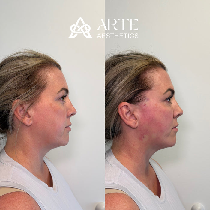 ARTE Signature Lift