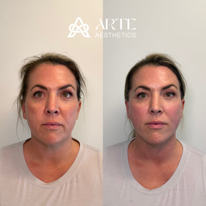 ARTE Signature Lift