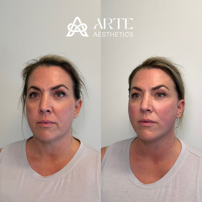 ARTE Signature Lift