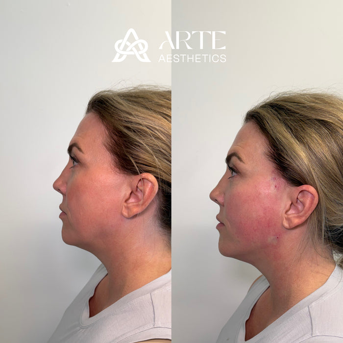 ARTE Signature Lift