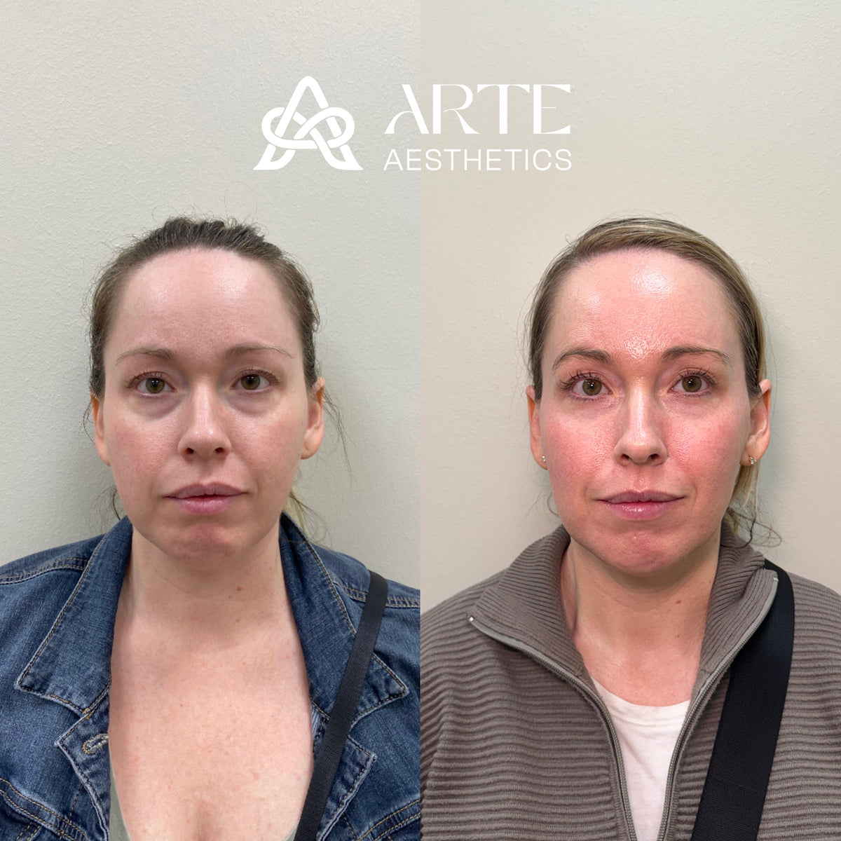 Facial skin rejuvenation before after Grapevine