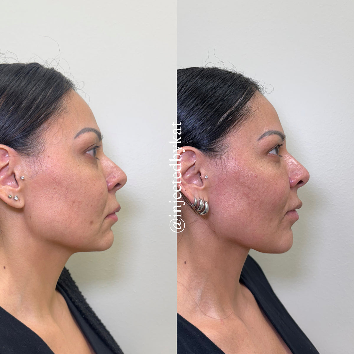 Cheek jawline filler profile results Grapevine