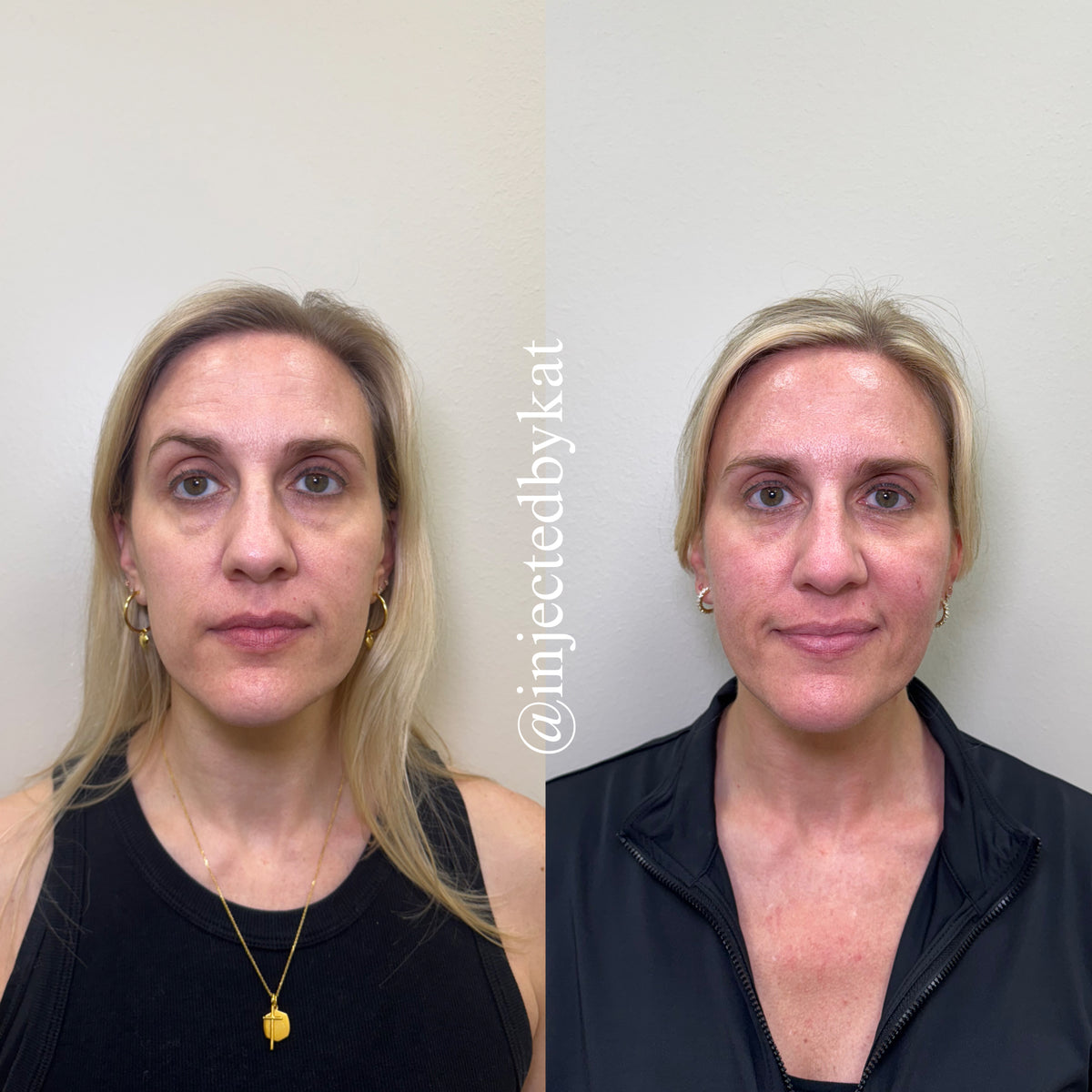 Even complexion skin treatment before after Grapevine