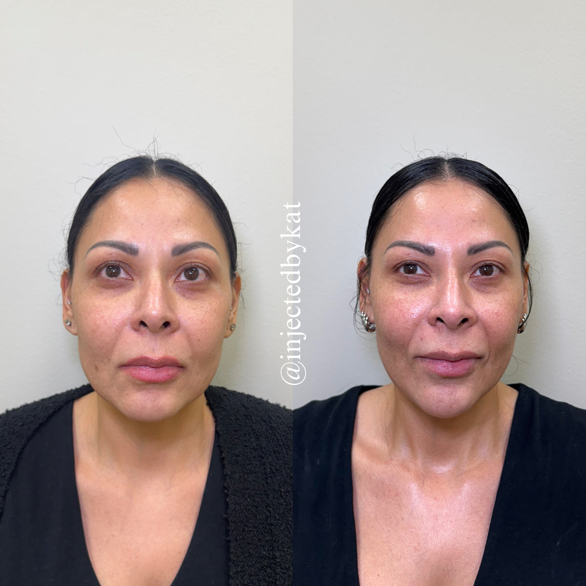 Smoother contoured facial results Grapevine Texas