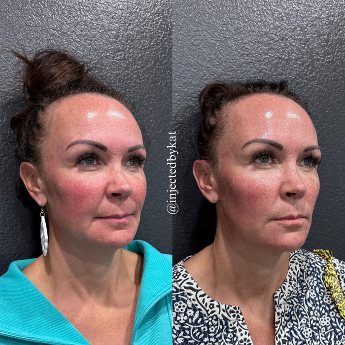 Collagen Restoration