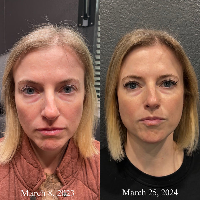 Collagen Restoration