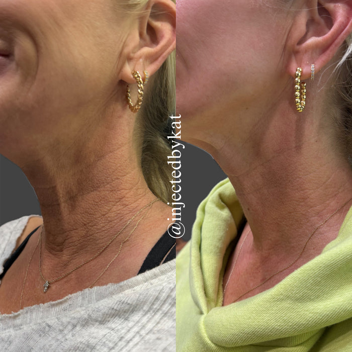 Collagen Restoration