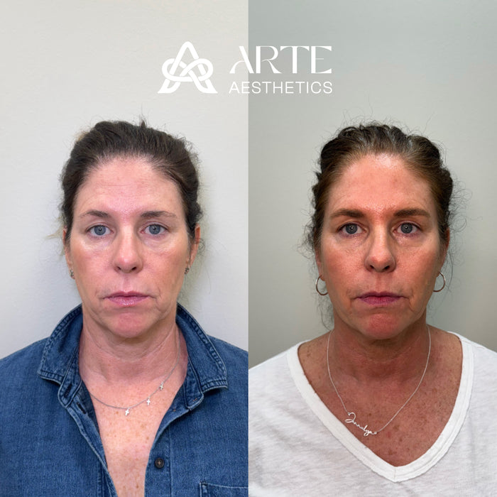 Collagen Restoration