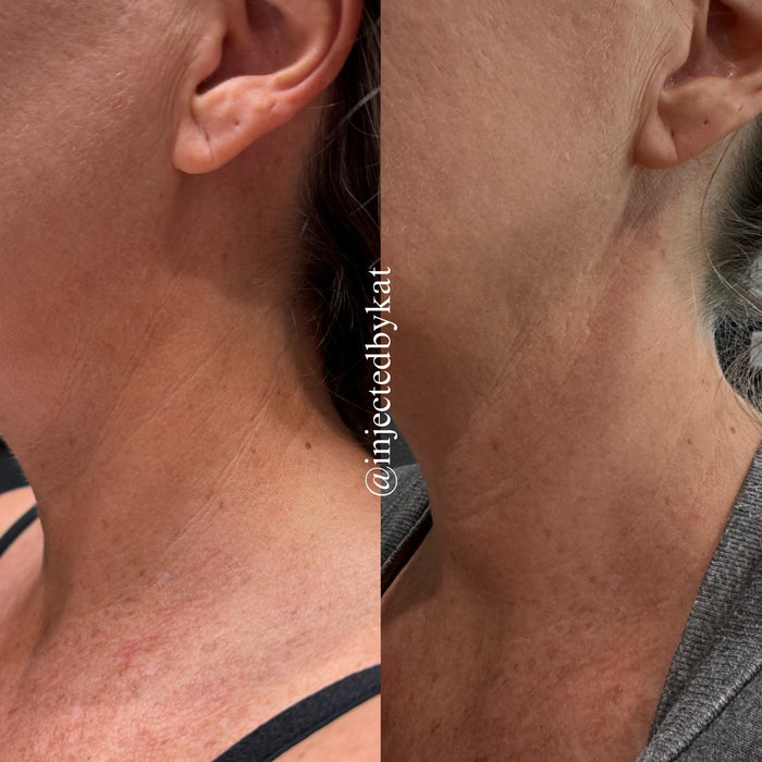 Collagen Restoration