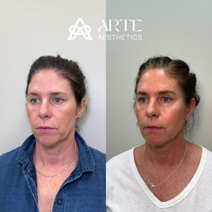 Collagen Restoration
