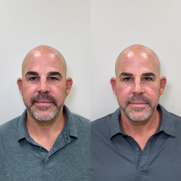 Collagen Restoration