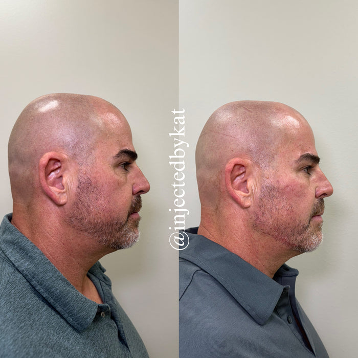 Collagen Restoration
