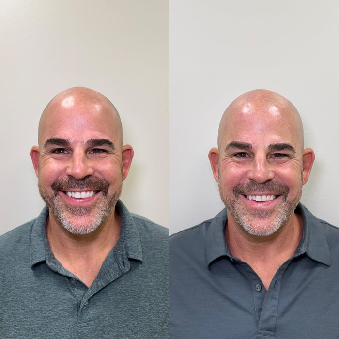 Collagen Restoration
