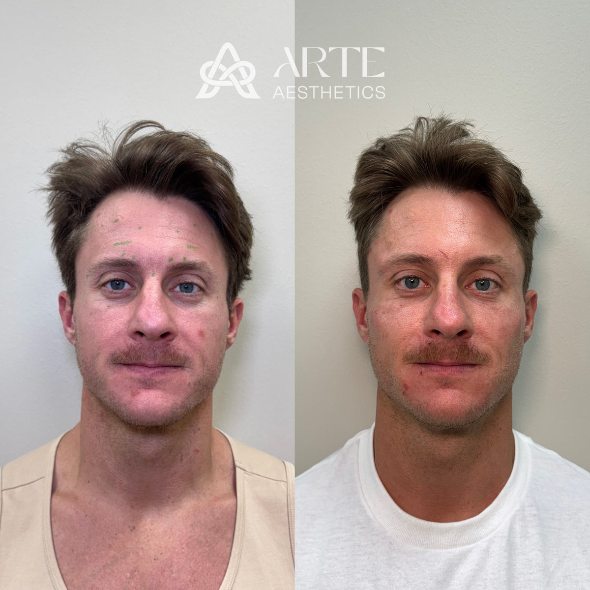 Clearer men's complexion skincare results Grapevine