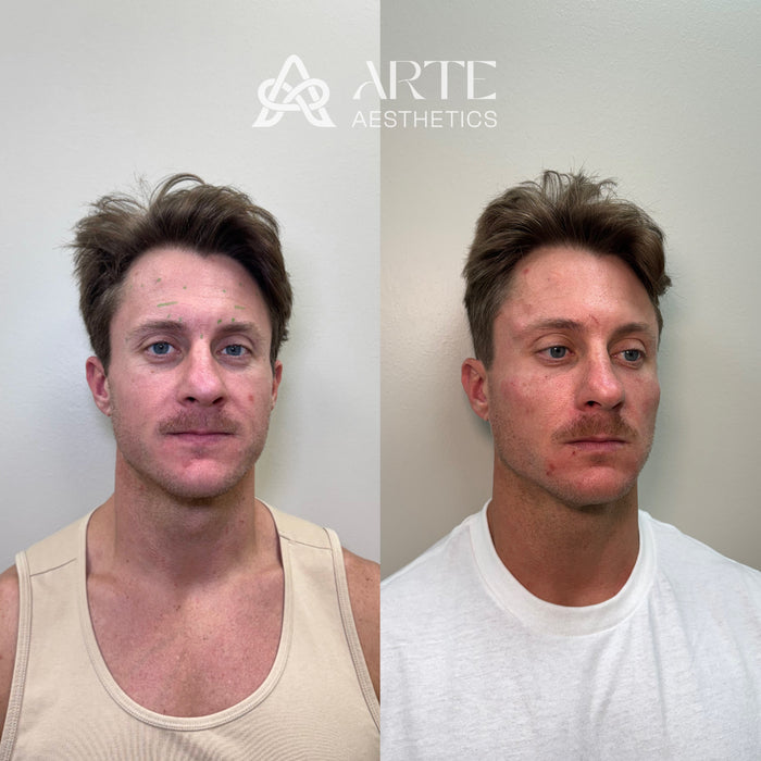 Restore & Contour