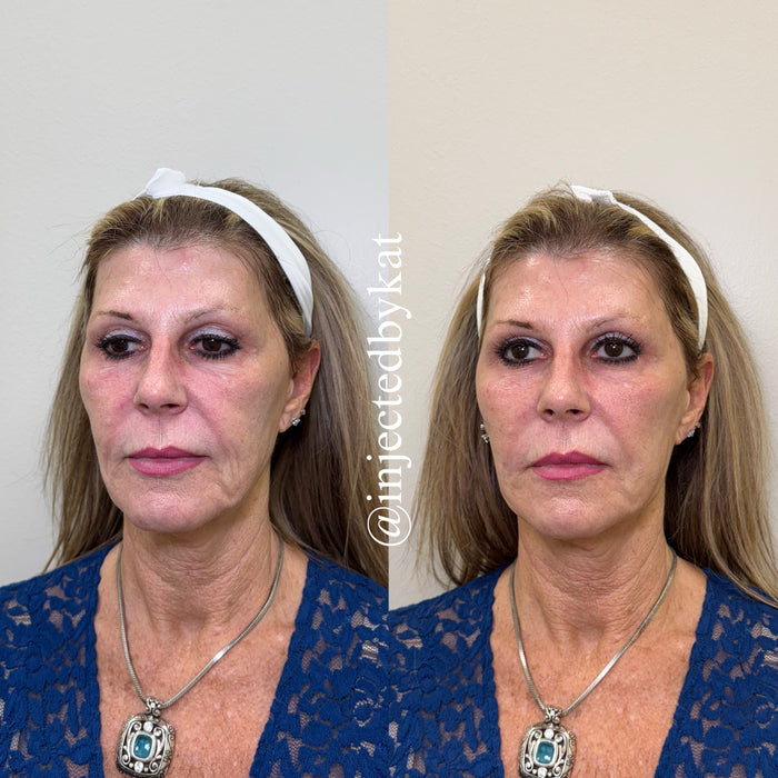 Restore & Contour