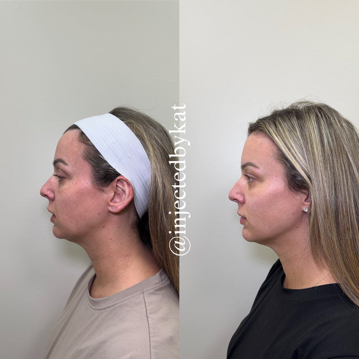 Restore & Contour