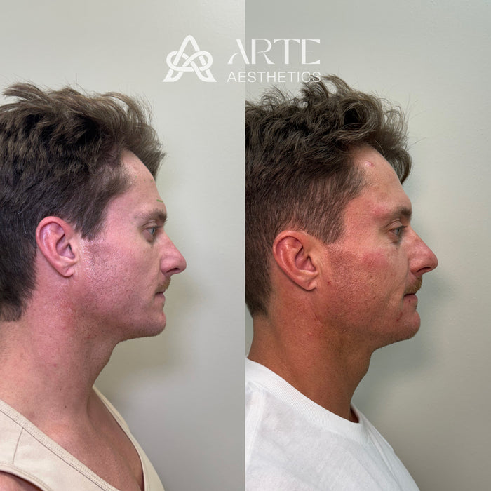 Restore & Contour