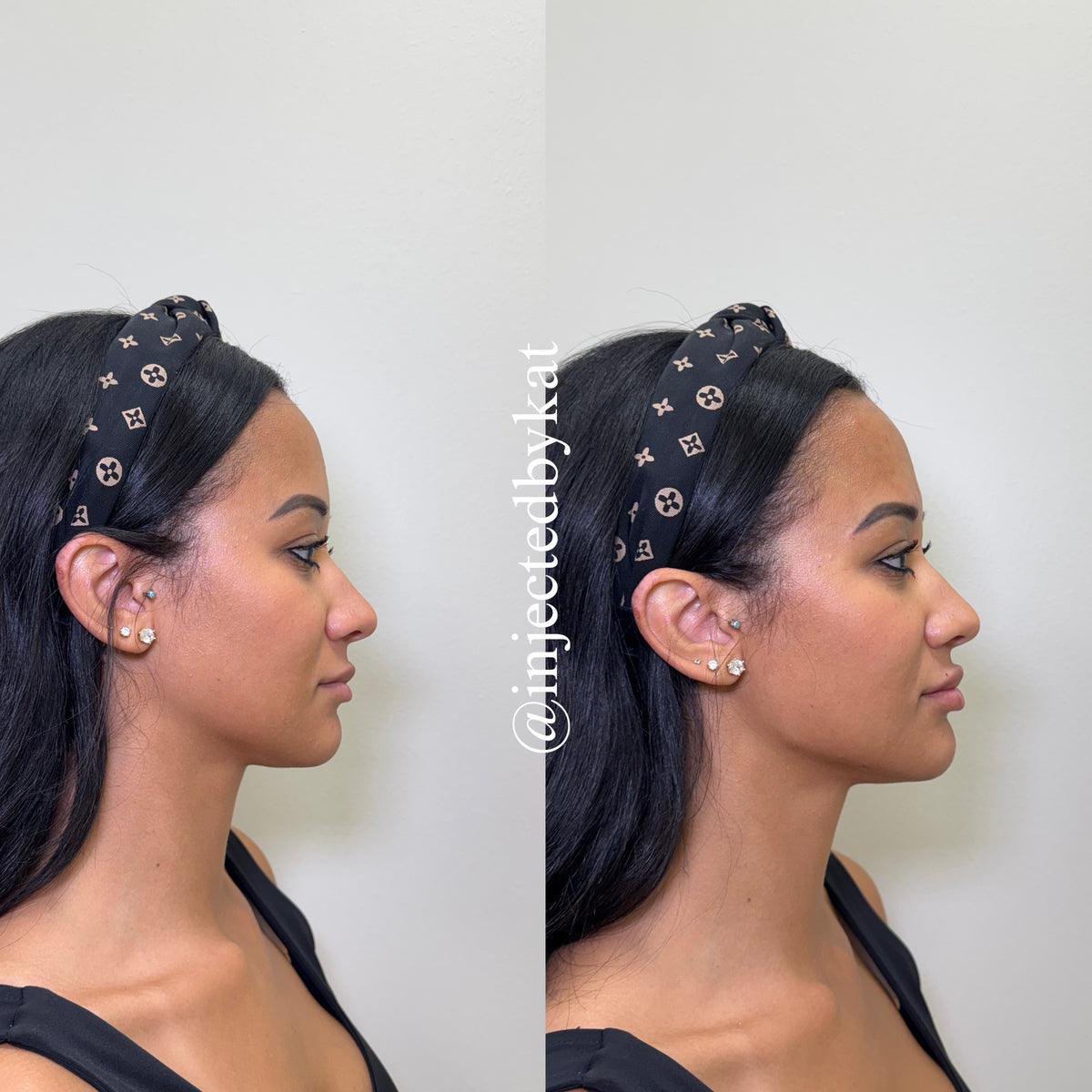 Chin jaw definition profile contouring Grapevine