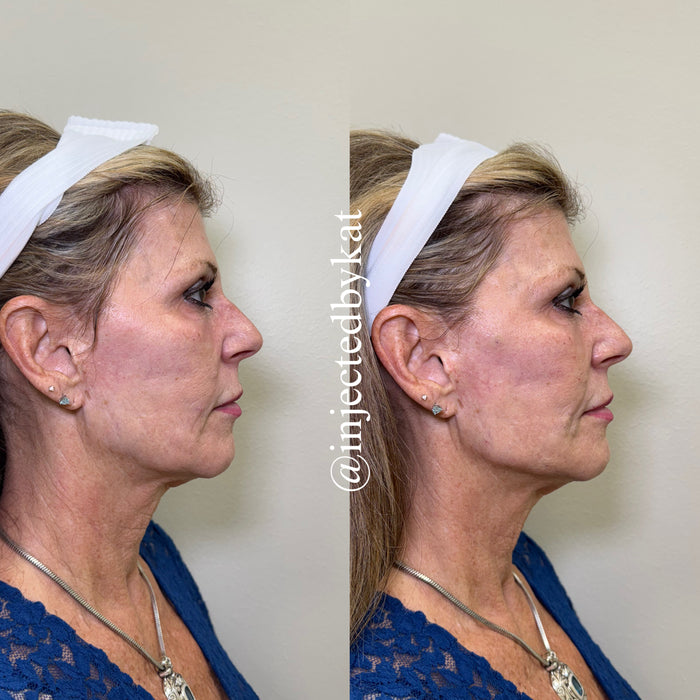 Restore & Contour
