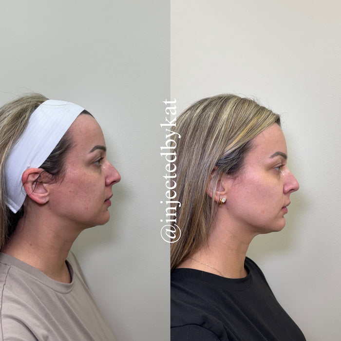 Restore & Contour