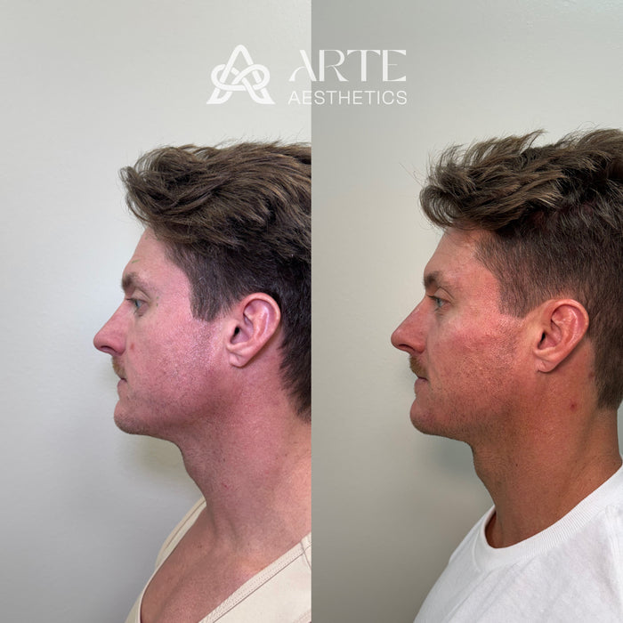 Restore & Contour