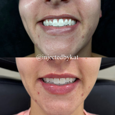 Before and after