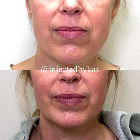 Before and after