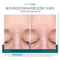 FACTORFIVE 7-Day Post-Treatment Kit